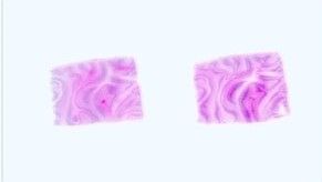 Paraffin Tissue Section - Human Lymph Nodes Tumor: Non-Hodgkin's Lymphoma, T Cell